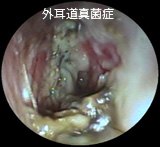 外耳道真菌症